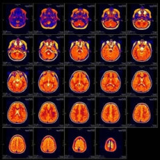 brain injury MRI